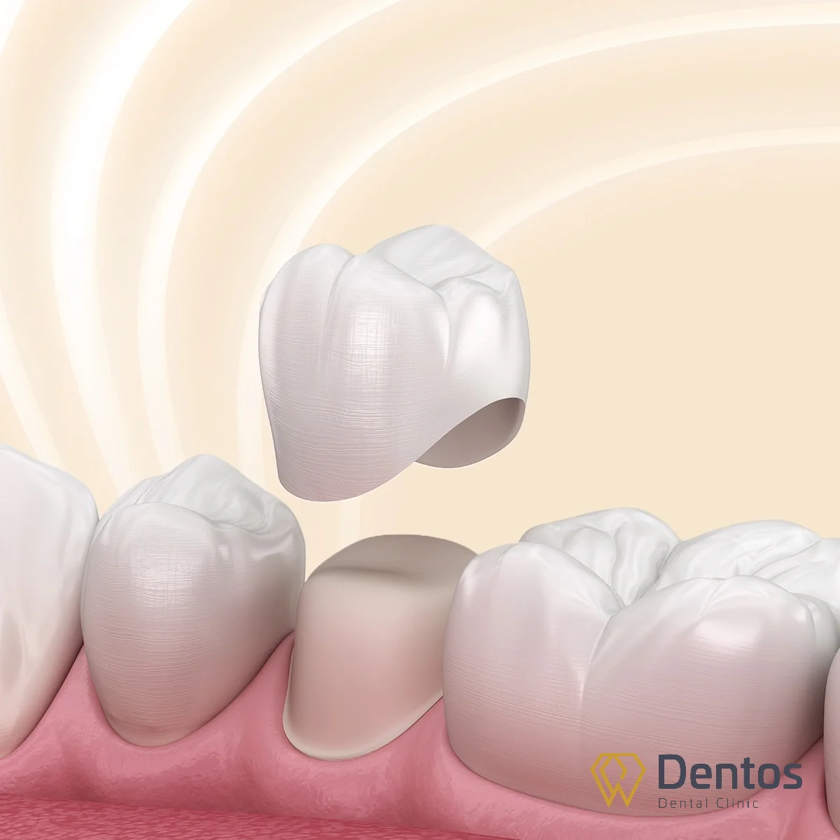 Bọc răng sứ giúp phục hình răng hư tổn, đem lại thẩm mỹ và bảo vệ răng thật.